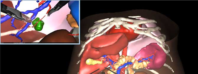 https://develop2.wp.ircad.net/wp-content/uploads/Liver-planning2.jpg
